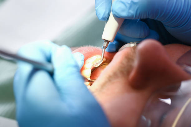 Best Emergency Tooth Extraction in Wellsboro, PA